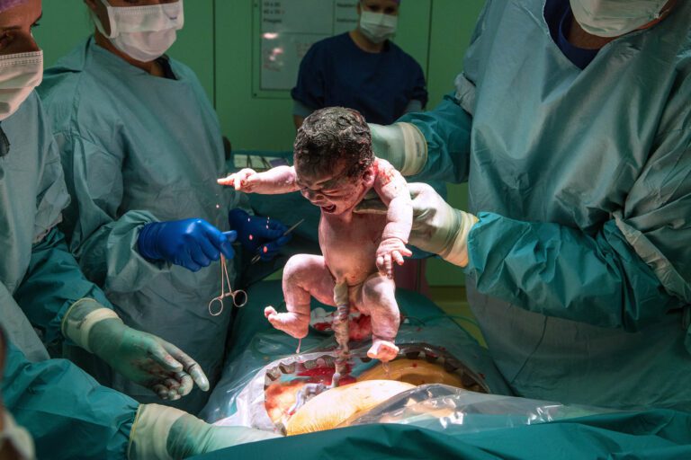 Het beeld toont het ontroerende moment van een geboorte in een operatiekamer. Een pasgeboren baby wordt omhooggehouden door een artsen, die omringd zijn door mensen in steriele operatiekledij. De diversiteit in de handelingen van de medische professionals benadrukken de precisie en zorg tijdens de bevalling. De pasgeborene komt net ter wereld en heeft nog de navelstreng vastzitten. De omgeving is steriel en helder verlicht, wat de intensiteit van het moment versterkt. Fotograaf: Jan Buwalda, Groningen.